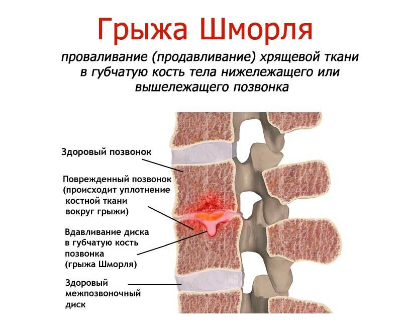 Радиальная грыжа колеса последствия: причины и способы устранения – Прокачай АВТО