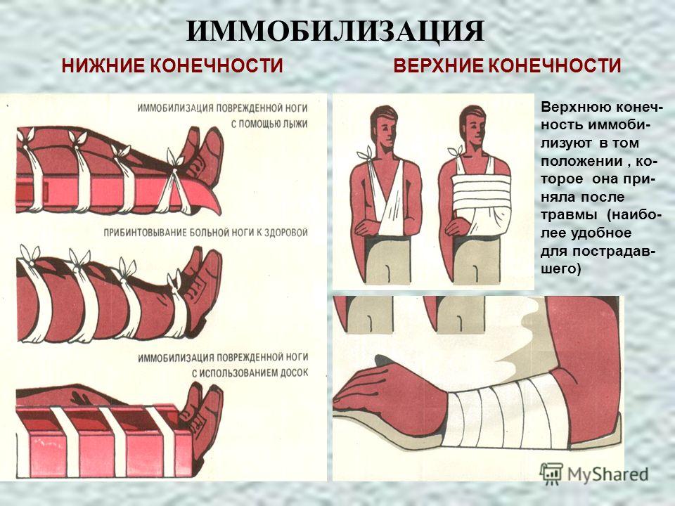 Шина транспортная для иммобилизации нижних конечностей