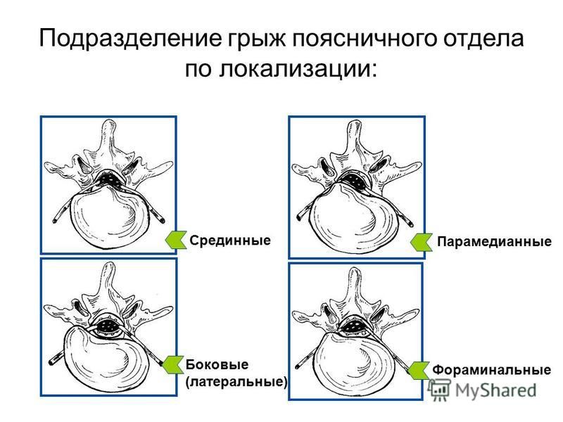 Радиальная грыжа колеса последствия: причины и способы устранения – Прокачай АВТО