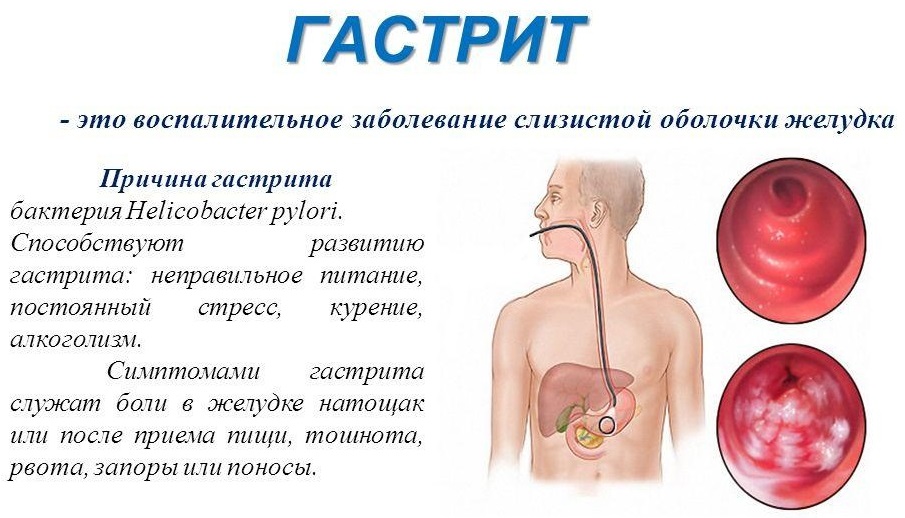 Почему тошнит в машине взрослого: Что делать если укачало в машиние, автобусе, самолете, поезде, марштрутке