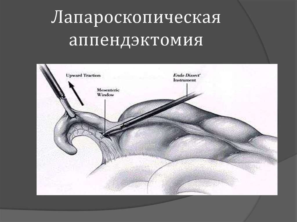 Как делают операцию аппендицит: Аппендэктомия (удаление Аппендицита)