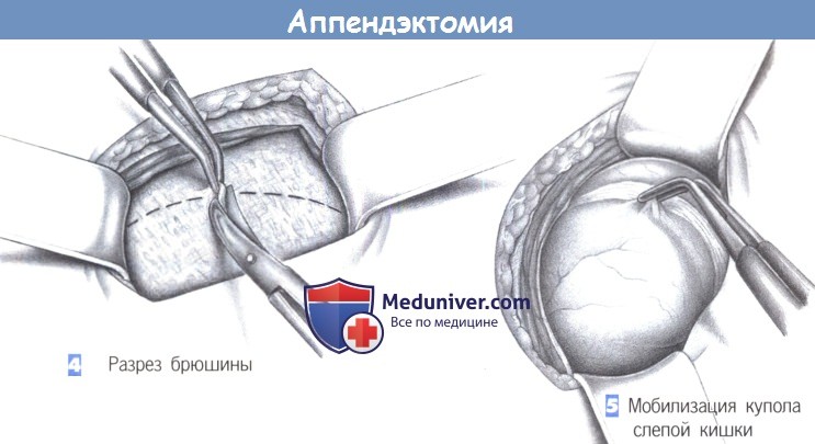 Аппендицит послеоперационный период. Этапы операции аппендэктомии. Лапароскопическая аппендэктомия этапы. Лапароскопическая аппендэктомия червеобразный отросток.