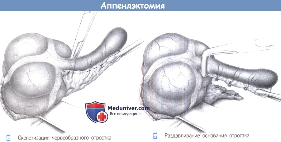 Как делают операцию аппендицит: Аппендэктомия (удаление Аппендицита)