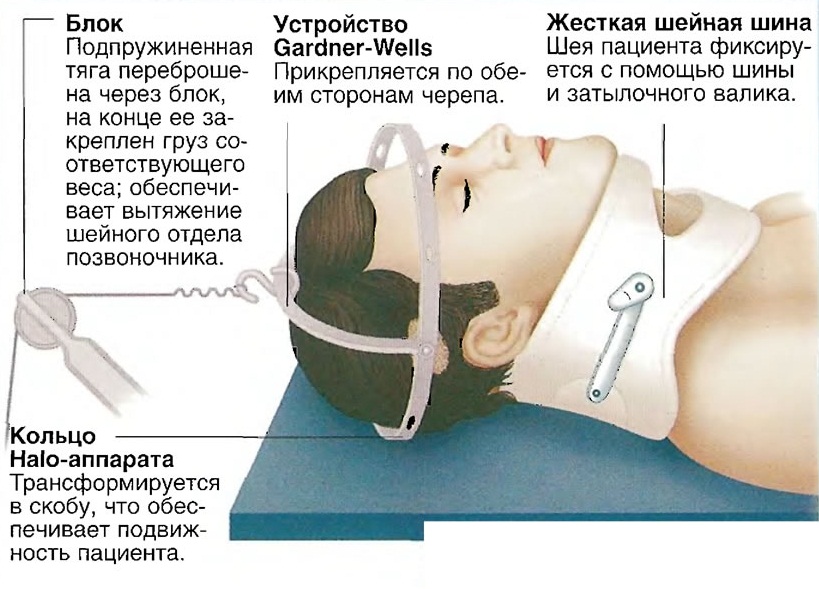 Операции грыжи шейного отдела позвоночника отзывы. При переломе 2 шейного позвонка. При повреждении шейного отдела позвоночника:. Передом шейный позвонков. При переломе шейного отдела позвоночника.