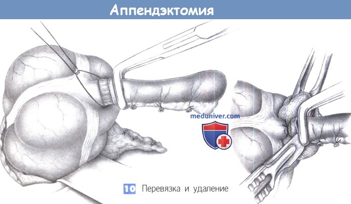 Как делают операцию аппендицит: Аппендэктомия (удаление Аппендицита)