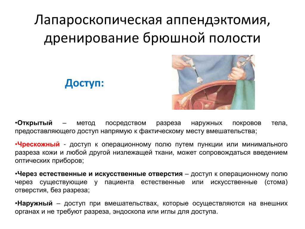 Как делают операцию аппендицит: Аппендэктомия (удаление Аппендицита)