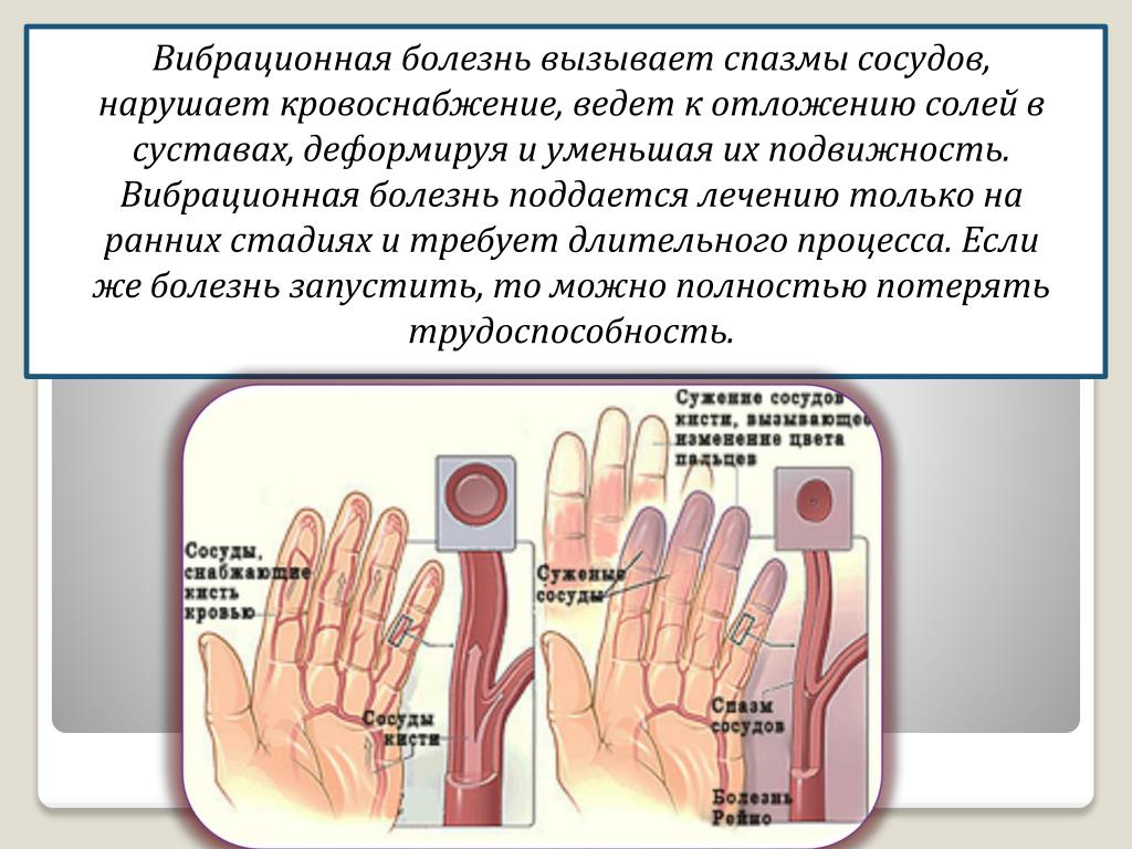 Какой форме вибрационной болезни подвержены водители: Какой форме вибрационной болезни подвержены водители