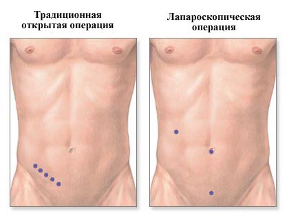 Как делают операцию аппендицит: Аппендэктомия (удаление Аппендицита)