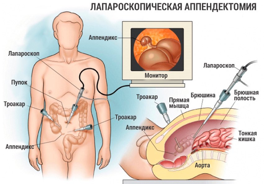 Как делают операцию аппендицит: Аппендэктомия (удаление Аппендицита)